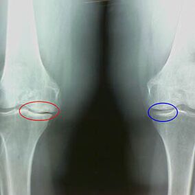 Arthroza articulației genunchiului pe radiografie